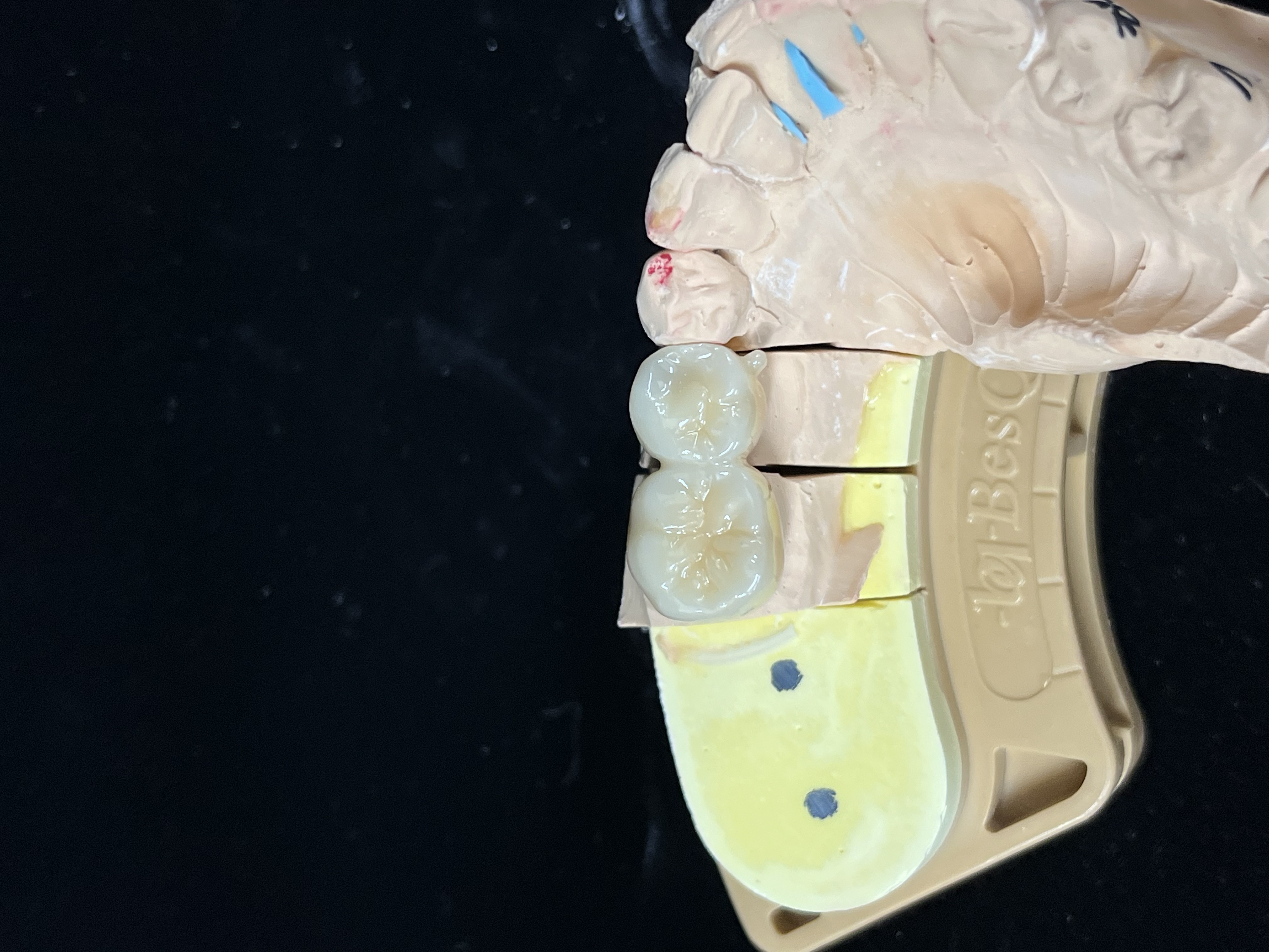 지르코니아 인레이 적합